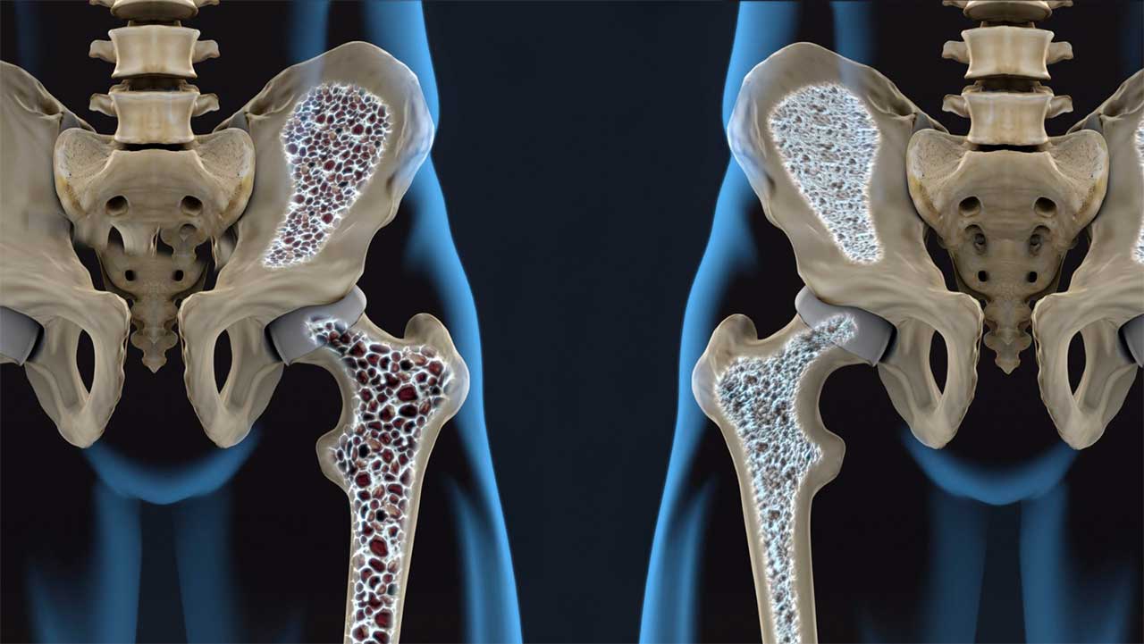 Entendendo a Osteoporose